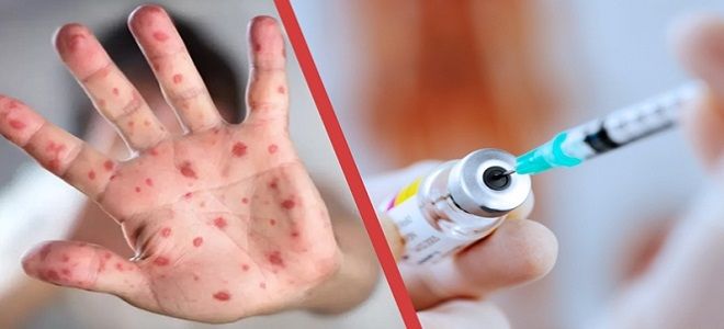 фото1 прививка от кори инвитро