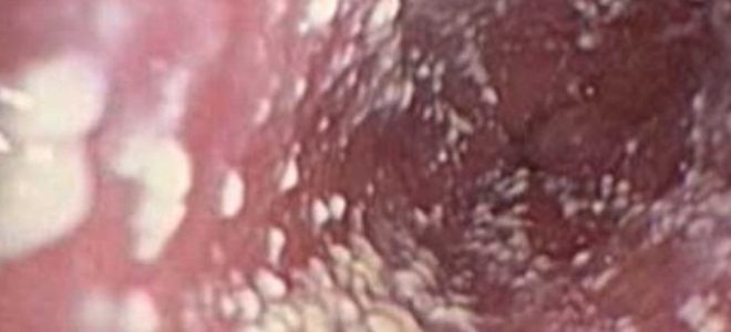 признаки молочницы у женщин признаки молочницы у женщин