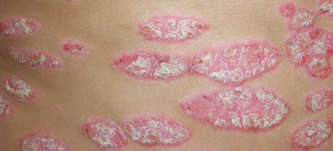 псориаз начальная стадия псориаз начальная стадия