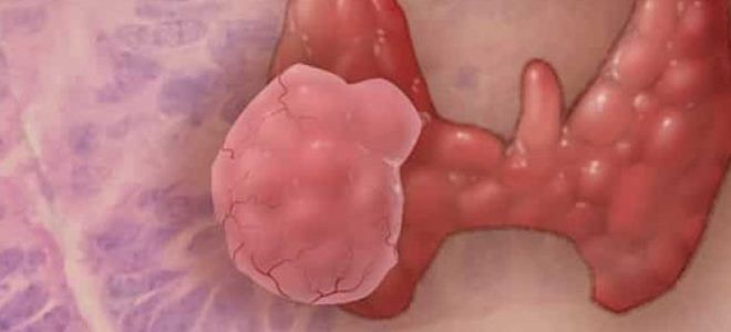 рак щитовидки рак щитовидки