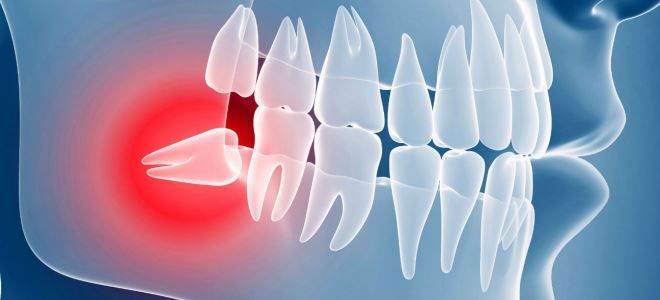 ретинированный зуб мудрости ретинированный зуб мудрости