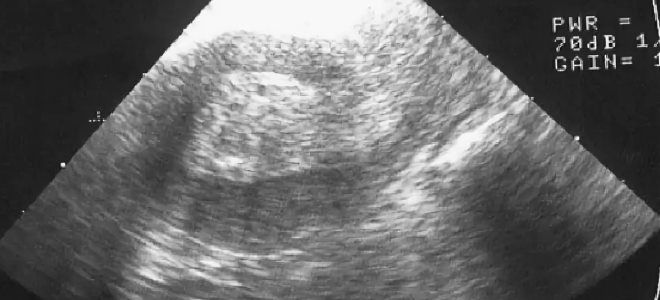 симптомы тонкого эндометрия симптомы тонкого эндометрия