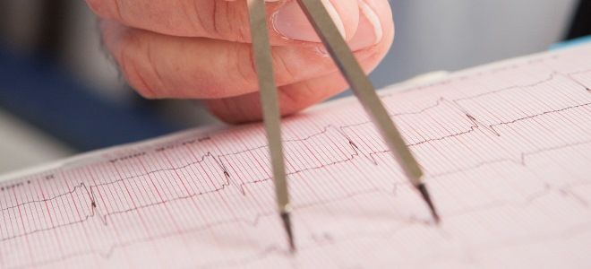 синдром wpw синдром wpw