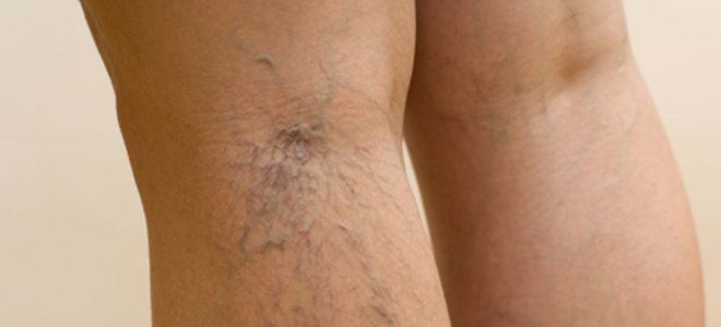 склеротерапия показания склеротерапия показания