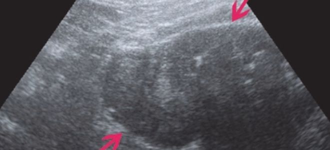 соли в почках соли в почках