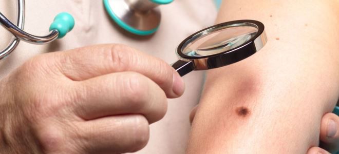 типы папиллом типы папиллом