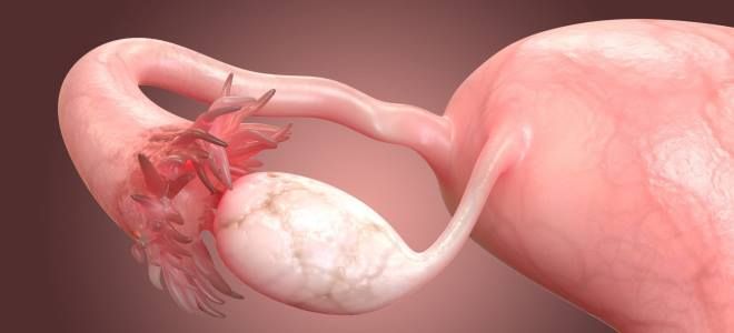 удаление кисты яичника удаление кисты яичника