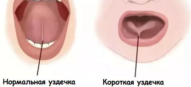 уздечка языка уздечка языка