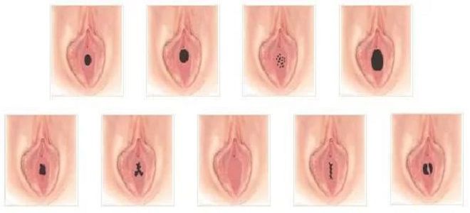 виды девственных плев виды девственных плев