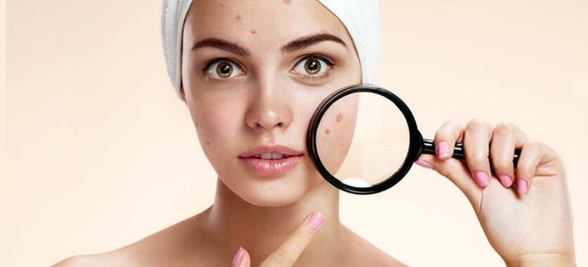 виды прыщей на лице виды прыщей на лице