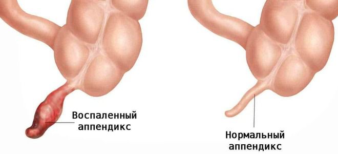 воспаление аппендикса воспаление аппендикса