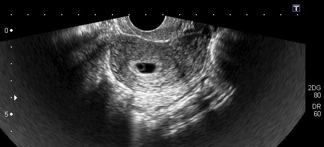 второй месяц беременности второй месяц беременности