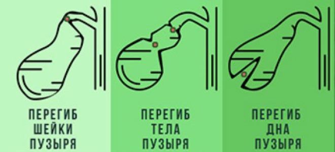 загиб желчного пузыря у ребенка загиб желчного пузыря у ребенка