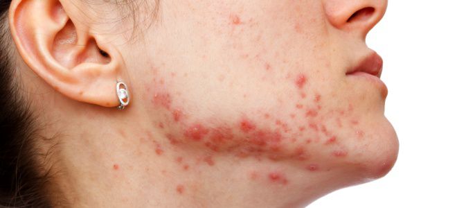 Золотистый стафилококк на лице Золотистый стафилококк на лице