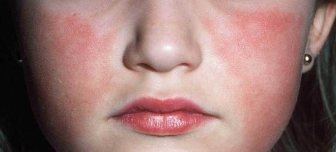 Инфекционная эритема у детей Инфекционная эритема у детей