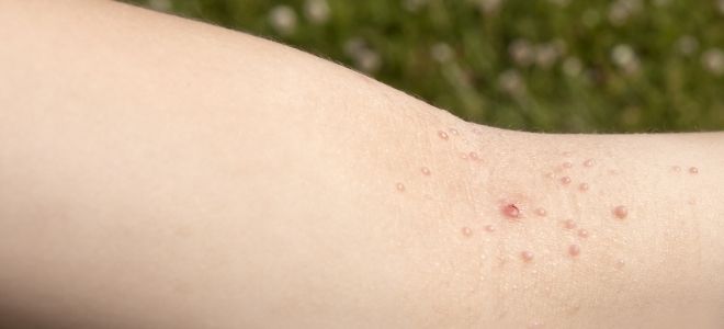 Контагиозный моллюск у детей Контагиозный моллюск у детей