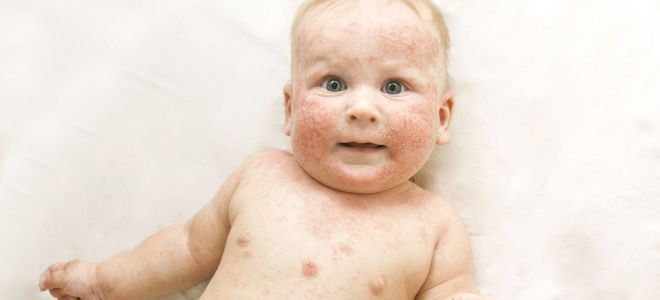 Экзема у детей Экзема у детей