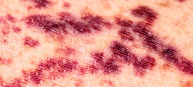 Менингококцемия у детей Менингококцемия у детей