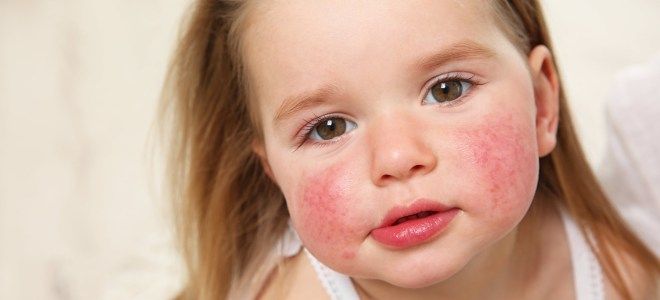 Аллергическая сыпь у детей Аллергическая сыпь у детей