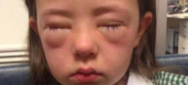 аллергия анафилаксия аллергия анафилаксия