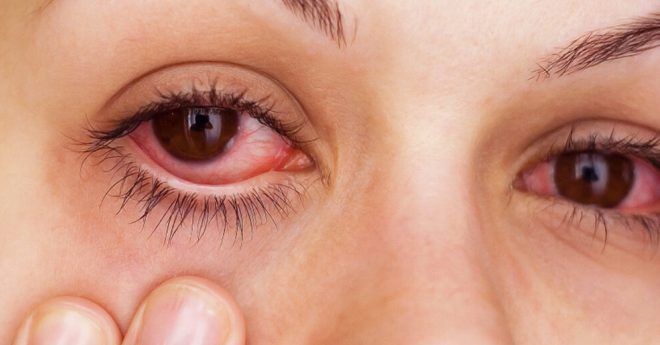 аллергия на кошек симптомы аллергия на кошек симптомы