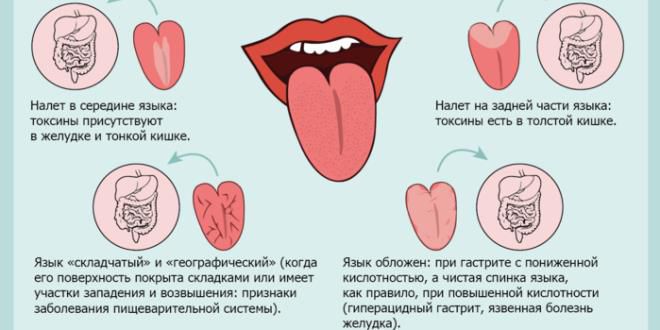 белый налет на языке признак какого заболевания белый налет на языке признак какого заболевания