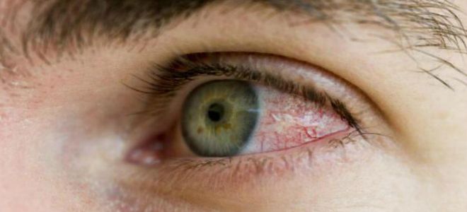 что делать при ожоге глаз что делать при ожоге глаз