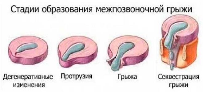 фото2 циркулярная протрузия диска