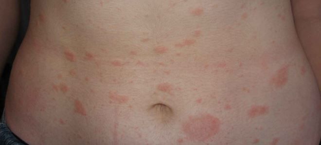 цветной лишай у человека симптомы цветной лишай у человека симптомы