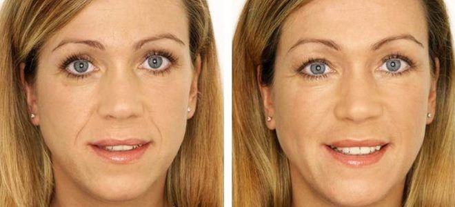 как проводится плазмолифтинг лица как проводится плазмолифтинг лица