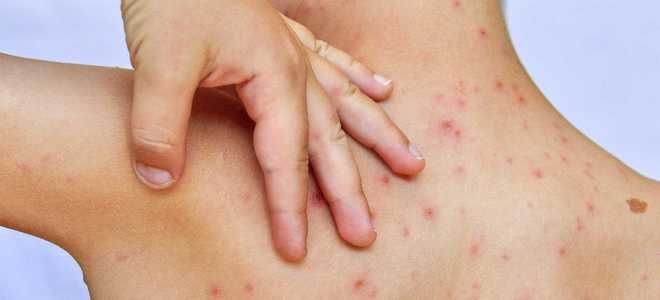 каламин при ветрянке каламин при ветрянке