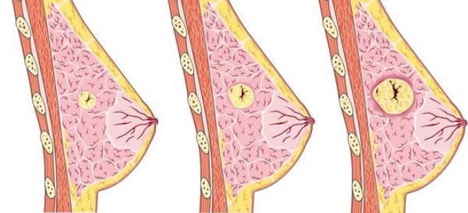 киста в груди лечение киста в груди лечение