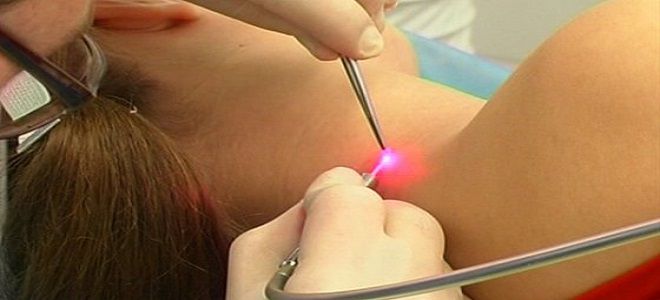 кондиломатоз лечение кондиломатоз лечение