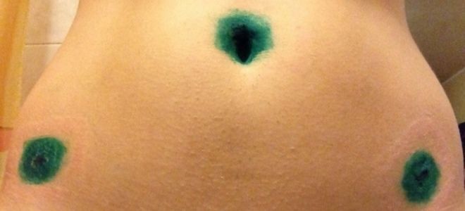 лапароскопия кисты лапароскопия кисты