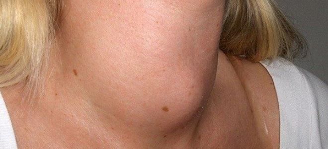 манифестный тиреотоксикоз манифестный тиреотоксикоз