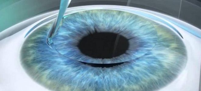 методы лазерной коррекции зрения методы лазерной коррекции зрения