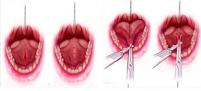 пластика уздечки языка пластика уздечки языка