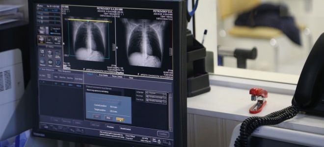 поражение легких при коронавирусе на кт поражение легких при коронавирусе на кт