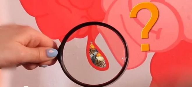 причины аппендицита причины аппендицита