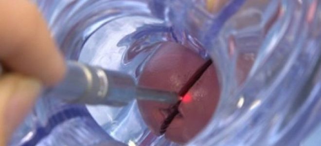 прижигание эрозии шейки матки прижигание эрозии шейки матки