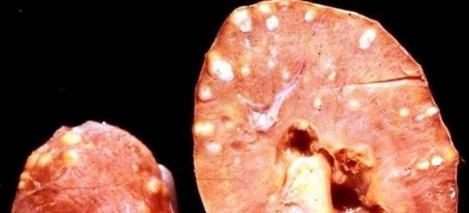 соль в почках причины соль в почках причины