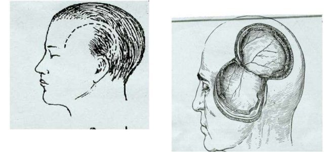 трепанация черепа виды трепанация черепа виды