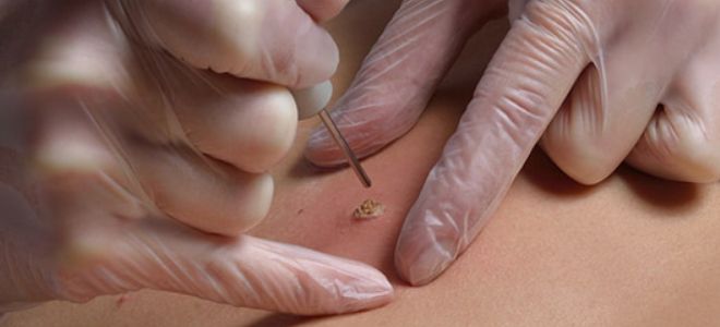 удалить папиллому лазером удалить папиллому лазером