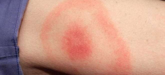 укус клеща боррелиоз укус клеща боррелиоз