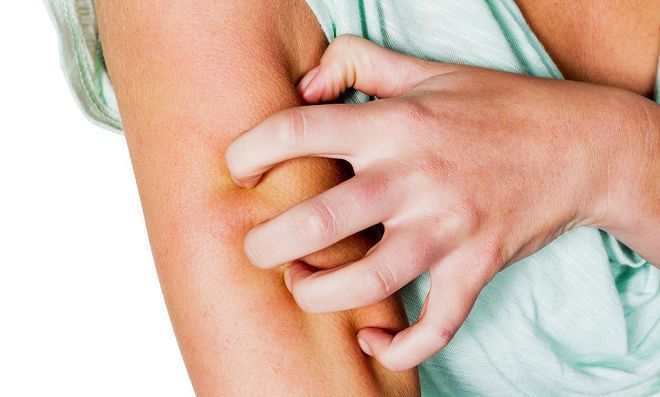 укусы клопов на человеке симптомы укусы клопов на человеке симптомы