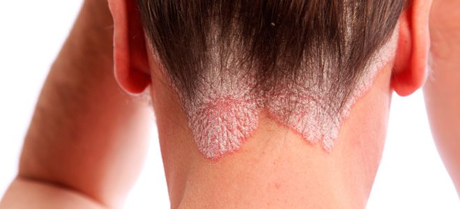 возникновение псориаза возникновение псориаза