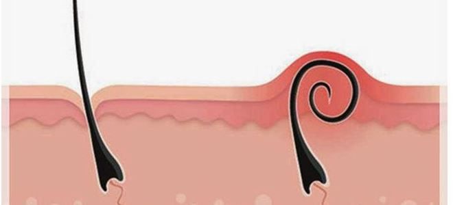 ихтиоловая мазь от вросших волос ихтиоловая мазь от вросших волос