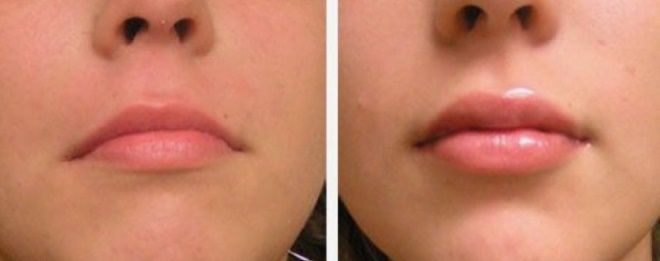 инъекции гиалуроновой кислоты за и против инъекции гиалуроновой кислоты за и против