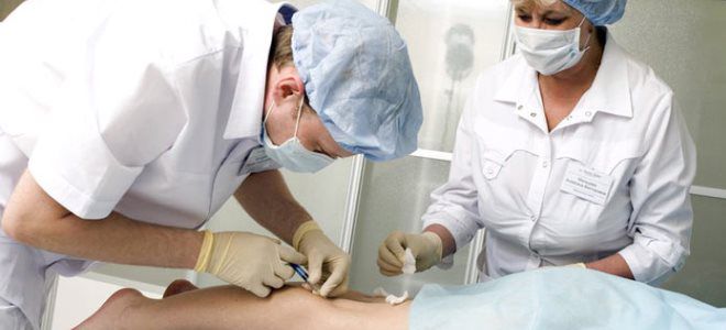 как проходит склеротерапия вен как проходит склеротерапия вен