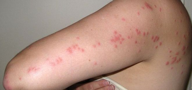 как выглядят укусы клопов как выглядят укусы клопов